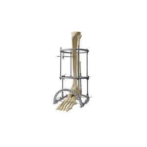 tibia external fixation system 1