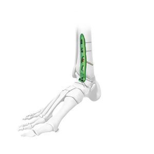 ankle arthrodesis plate 1