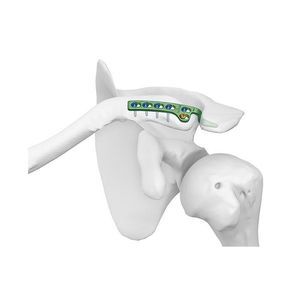 clavicle compression plate 1