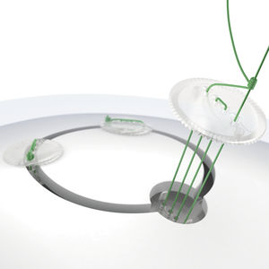 absorbable cranial fixation system