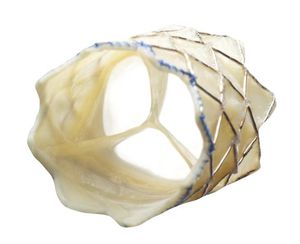 pulmonary valve bioprosthesis