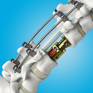 cervical vertebral corpectomy prosthesis