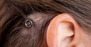 internal component bone conduction hearing implant / body-worn processor / pediatric