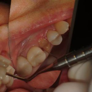 curved periotome