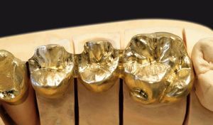 metal dental material
