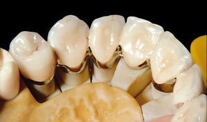 metal dental material