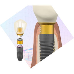 cylindrical implant abutment