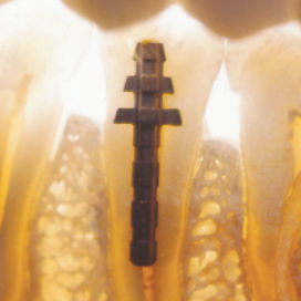 metal root post