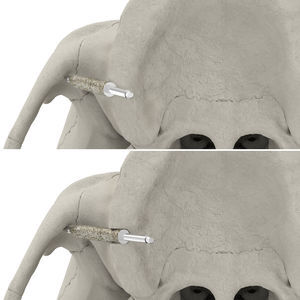implant osteotomy drill bit