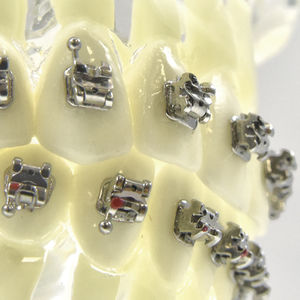 self-ligating orthodontic bracket