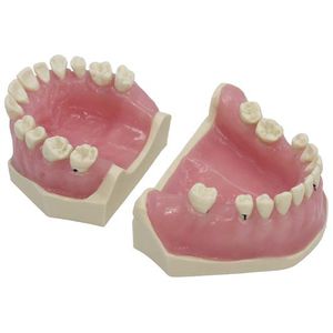 denture model / for teaching / pathological / for periodontics