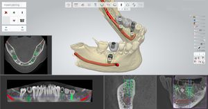 guided surgery software