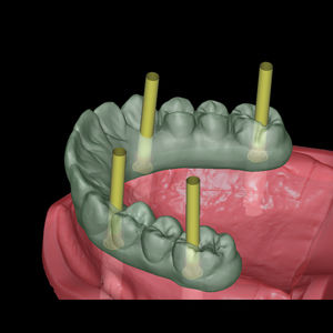 dental implantology software module