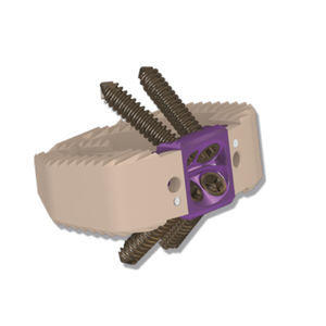lumbar interbody fusion cage 1