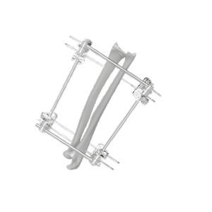 tibia external fixation system