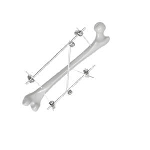femur external fixation system