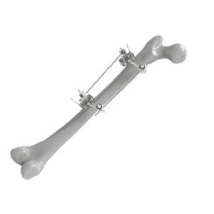 femur external fixation system
