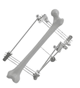 femur external fixation system