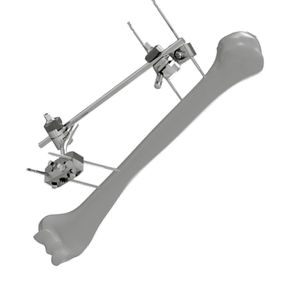 Radius External Fixation System - 206302 - SOFEMED International - Ulna ...