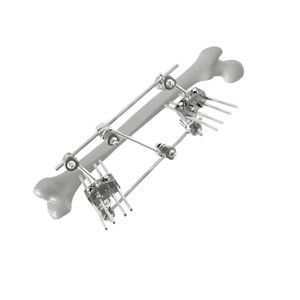 femur external fixation system