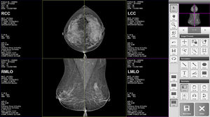 mammography software