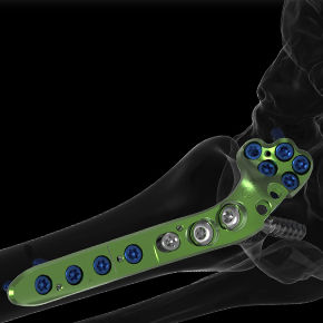 metatarsophalangeal joint arthrodesis plate