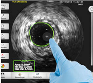 intravascular ultrasound imaging software