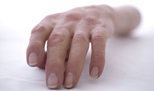 arm cosmetic prosthesis 1