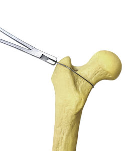 metalic monofilament bone cerclage wiring