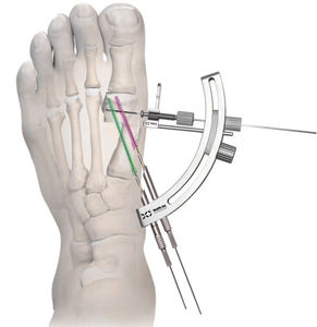 minimally invasive forefoot surgery instrument kit