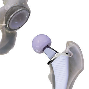 Cementless hip prosthesis, Press-fit hip prosthesis - All medical ...