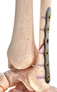 fibula compression plate / lateral