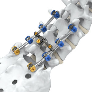 lumbo-sacral osteosynthesis unit