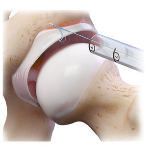 acetabular labrum suture anchor