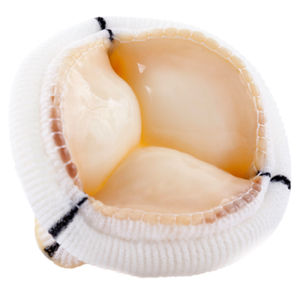 mitral valve bioprosthesis