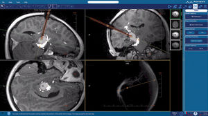 Brain tumor treatment laser ablation system - NeuroBlate® - Monteris ...