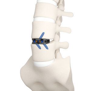 Lumbar Interbody Fusion Cage - Dyna-link® Elite - Life Spine - Anterior