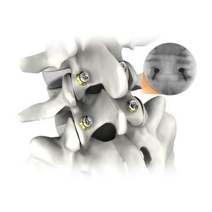 thoraco-lumbar osteosynthesis unit 1