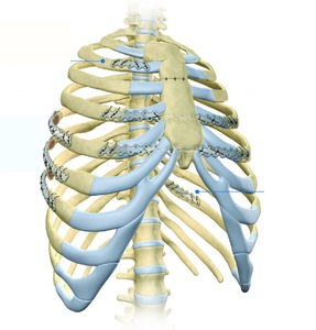 rib compression plate