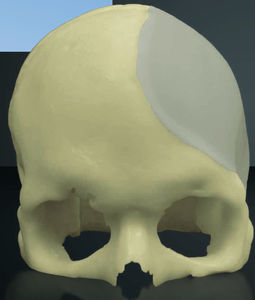 custom-made cranial implant