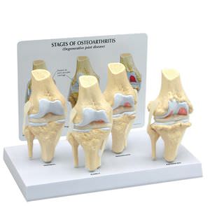 knee model / joint / pathological