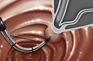 biliary sphincterotomy sphincterotome
