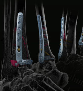tibia compression plate