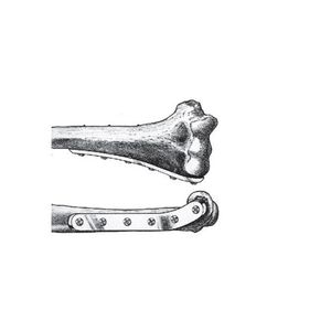 humerus compression plate