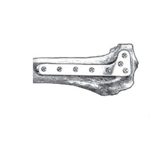 tibia compression plate