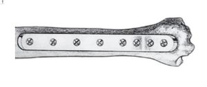 tibia compression plate