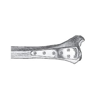 tibia compression plate