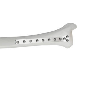 tibia compression plate 1