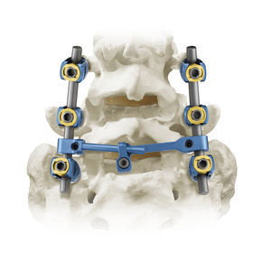 thoracic-lumbar vertebra pedicle screw