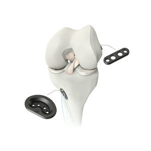 anterior cruciate ligament ligament prosthesis